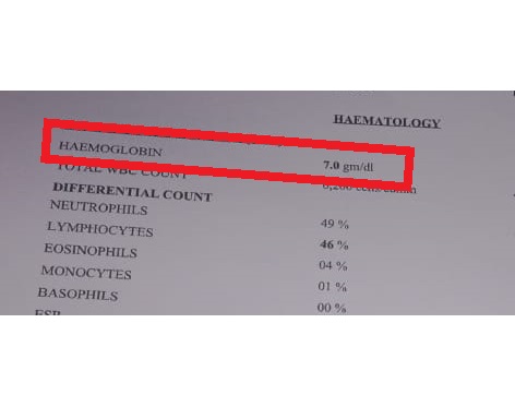Anemia before treatment