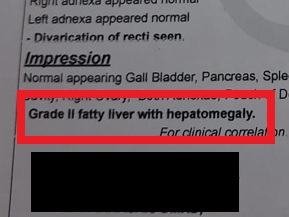 Fatty Liver before treatment