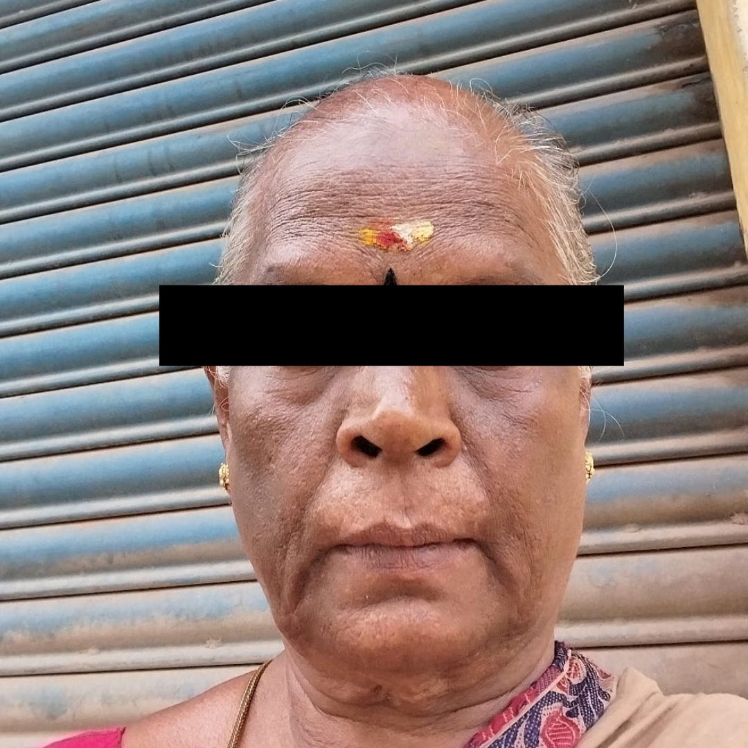 Melasma after treatment
